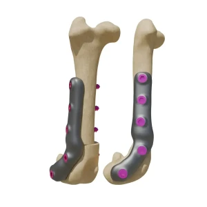 Individualised Ti-alloy implants