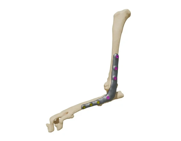 pap-implant (1)