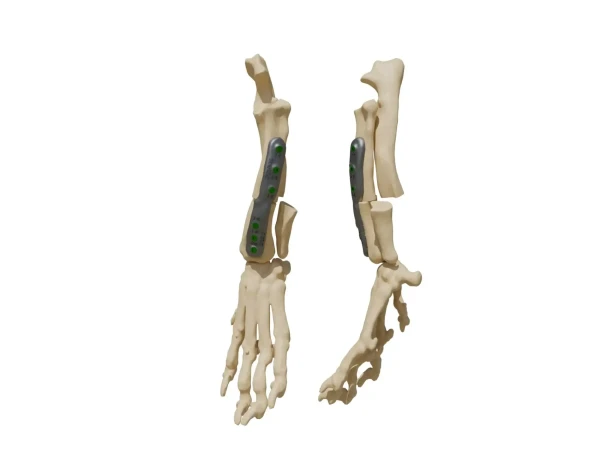 rcp-implant (1)