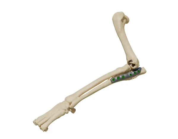 ter-implant (1)